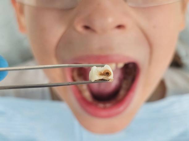 Best Emergency Dental Extractions in Mason City, IL